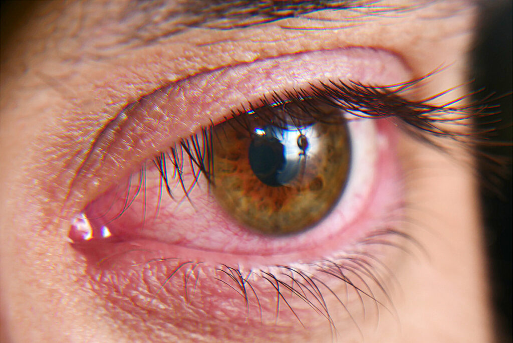 A patient with dry eye syndrome