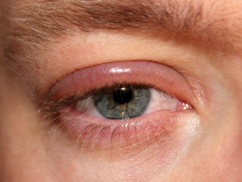 A picture of a patient with an inflamed upper-eyelid (also called Anterior Blepharitis)