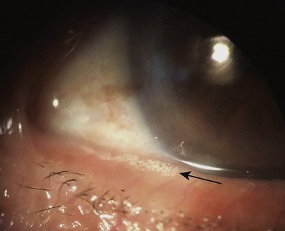 A picture of Saponification (or bubbles) occuring along a patient's eyelid margin.