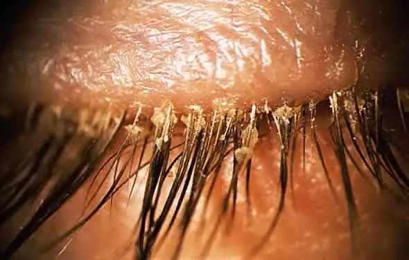 An image of demodex on the eye lashes.