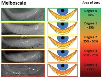 Meibomian Gland atrophy chart