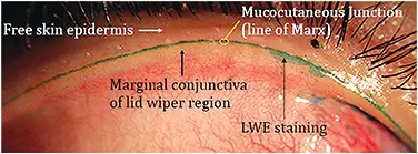 A diagram showing lip wiper epitheliopathy